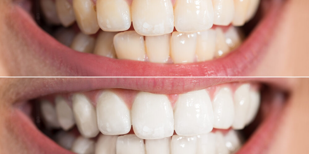 tristate teeth whitening teeth whitening before and after