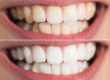 teeth whitening before and after