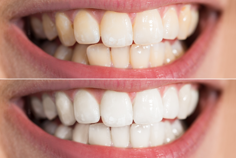 tristate teeth whitening teeth whitening before and after