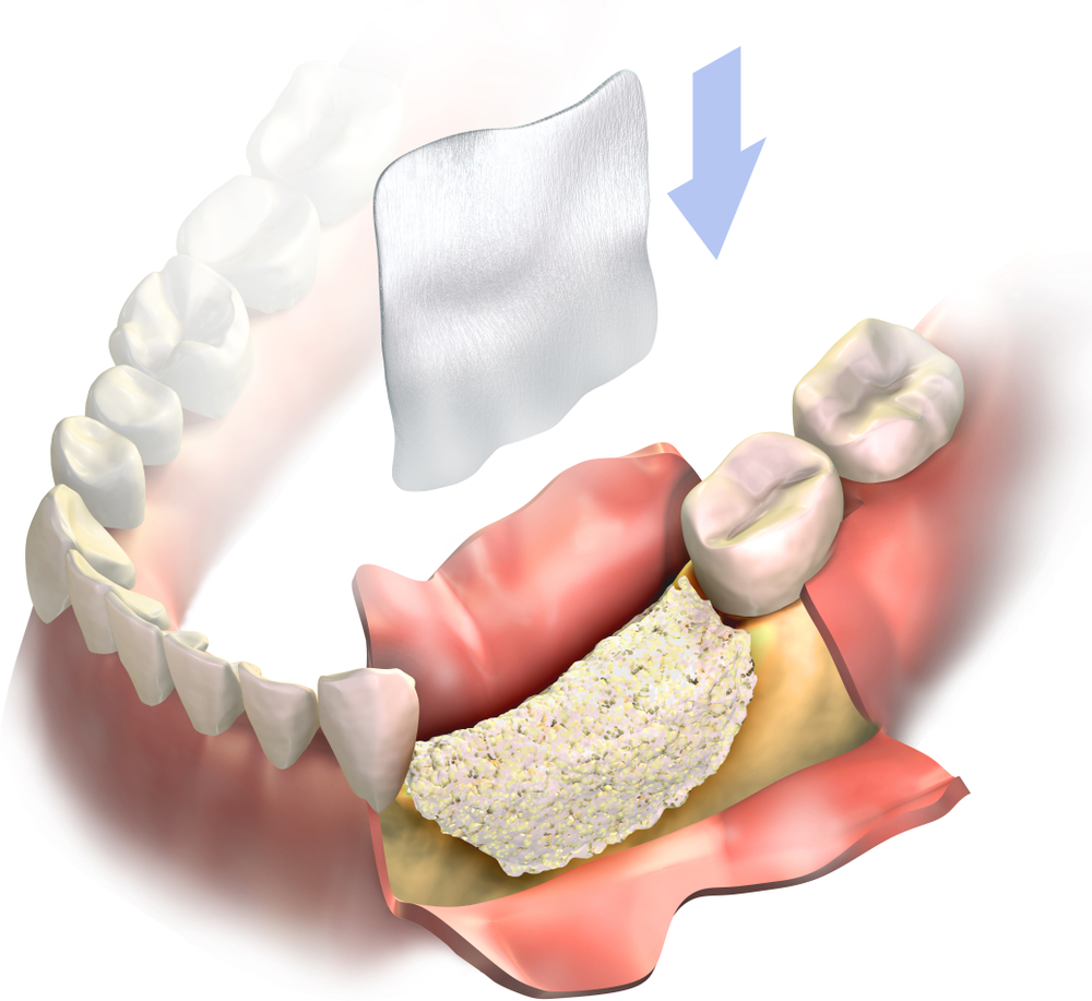 What is a Dental Bone Graft and How is It Done? TriState Dental Care